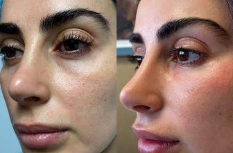 Best Clinic for Adults for Dermal Filler for Under Eye Hollows Problem