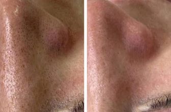 Best Clinic for Women for Chemical Peel for Open Pores Problem