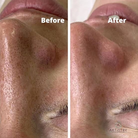 Best Clinic for Women for Chemical Peel for Open Pores Problem