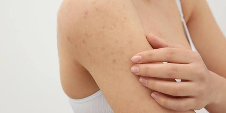 Best Dermatologist Advice for Adults for Keratosis Pilaris Problem