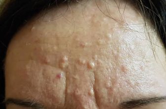 Best Dermatologist Advice for Sebaceous Hyperplasia