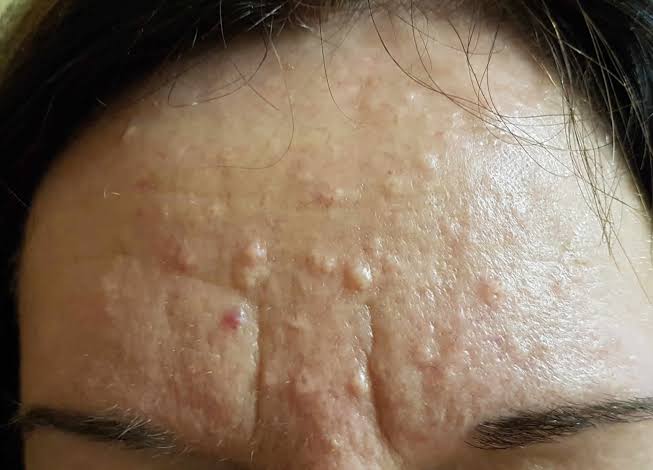 Best Dermatologist Advice for Sebaceous Hyperplasia