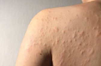 Best Dermatologist Near Golf Course Road Gurgaon for Skin Allergy Problem