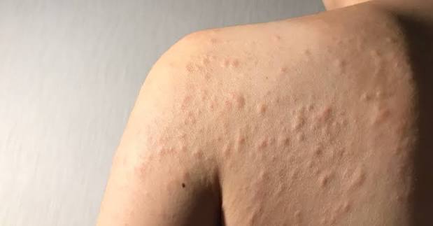 Best Dermatologist Near Golf Course Road Gurgaon for Skin Allergy Problem