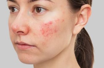 Best Dermatologist Solution for Adults for Actinic Keratosis Problem