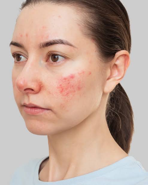Best Dermatologist Solution for Adults for Actinic Keratosis Problem