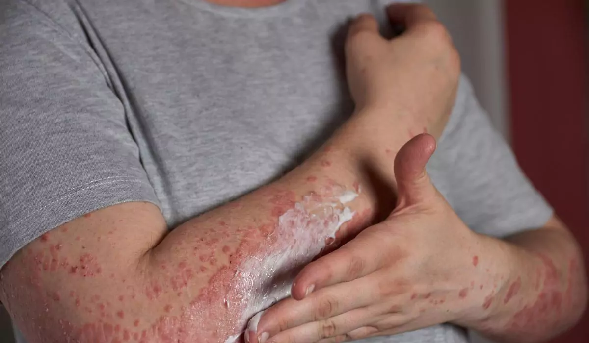 Best Dermatologist Treatment for Adults for Lichen Planus Problem