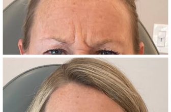 Best Dermatologist for Women for Botox for Forehead Lines Problem