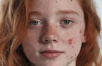 Best Dermatologist in Gurgaon for Teenage Acne Problem