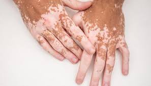 Best Dermatologist in Gurgaon for Vitiligo Treatment Problem