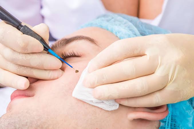 Best Recovery Tips for Adults After Mole Removal Surgery Problem