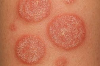 Best Remedy for Adults for Nummular Eczema Problem
