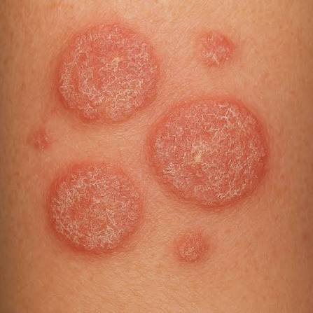 Best Remedy for Adults for Nummular Eczema Problem