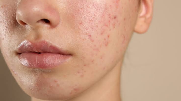 Best Remedy for Teenagers for Steroid Induced Acne Problem