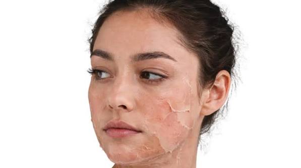 Best Skin Care Routine After Chemical Peel Treatment Problem