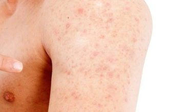 Best Skin Care for Athletes for Heat Rash Problem