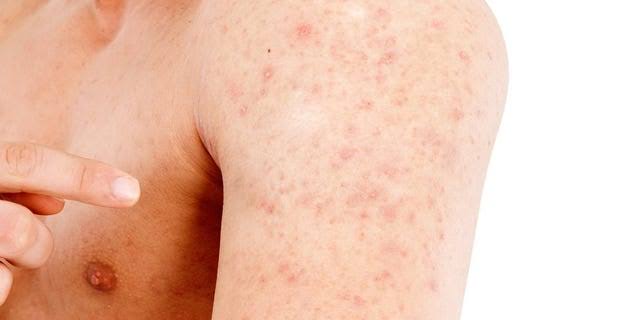 Best Skin Care for Athletes for Heat Rash Problem