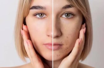 Best Skin Clinic for Pigmentation Problem