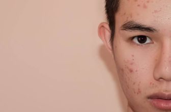 Best Skin Clinic in Gurgaon for Men's Skincare Problem