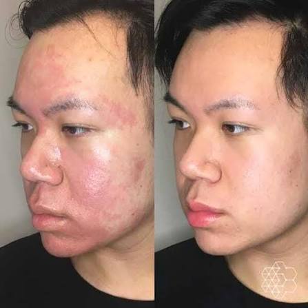 Best Dermatologist for Adults for Microneedling for Acne Scars Problem