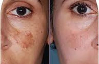 Best Skin Specialist Near Me in Gurgaon for Melasma Problem