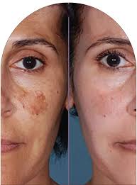 Best Skin Specialist Near Me in Gurgaon for Melasma Problem