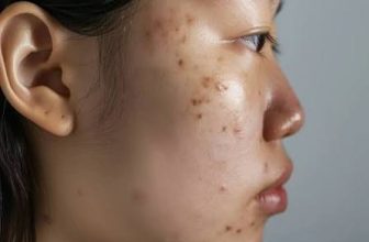 Best Skin Treatment for Adults for Post Inflammatory Hyperpigmentation Problem