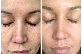 Best Treatment for Adults for Laser Toning for Uneven Skin Tone Problem