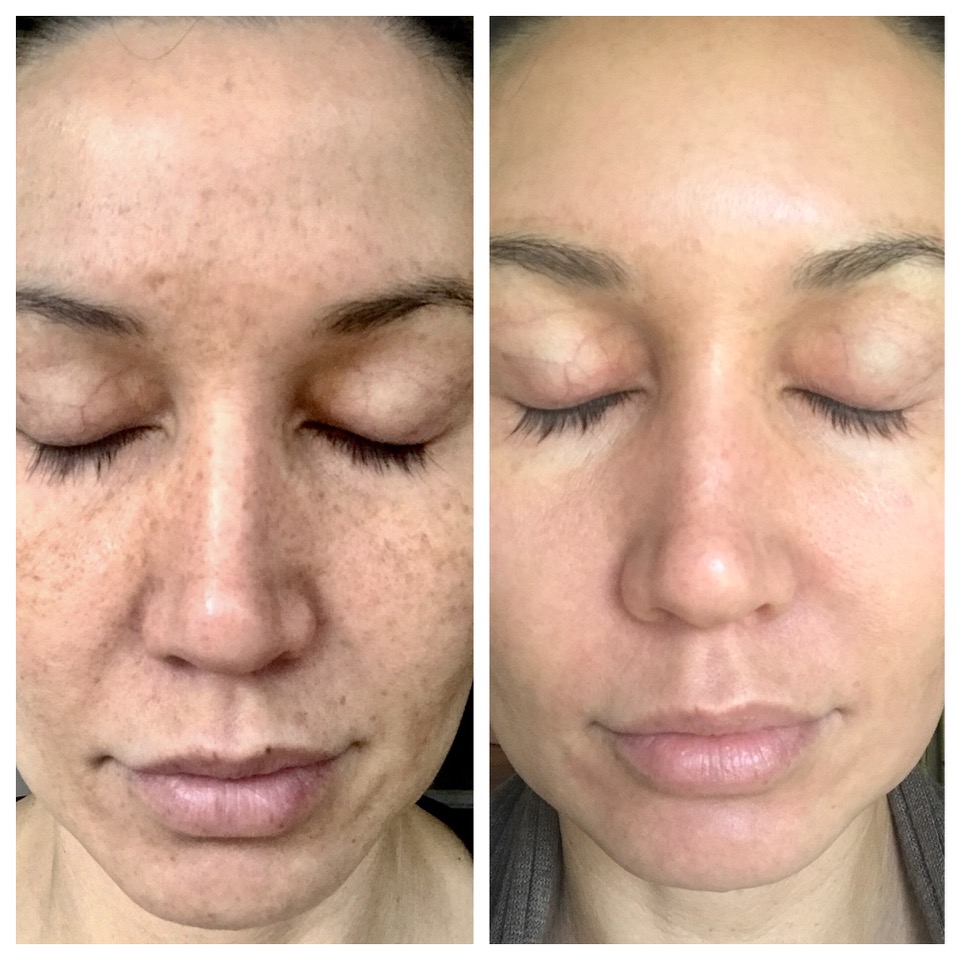 Best Treatment for Adults for Laser Toning for Uneven Skin Tone Problem