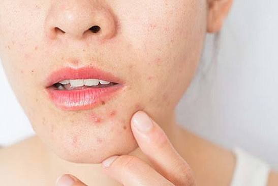 Best Treatment for Adults for Perioral Dermatitis Problem