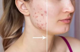 Best Treatment for Teenagers for Salicylic Acid Peel for Acne Problem