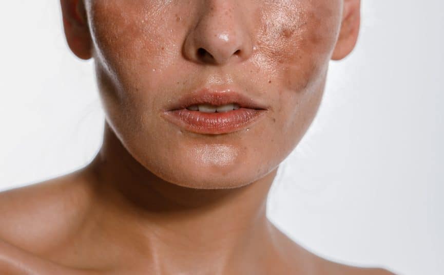Best Treatment for Women for Chloasma Skin Problem
