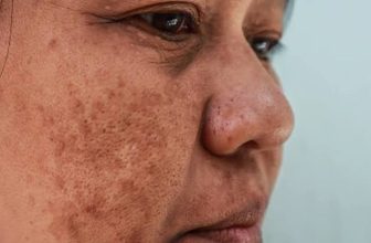 Best Clinic for Adults for Chemical Peel for Melasma Problem