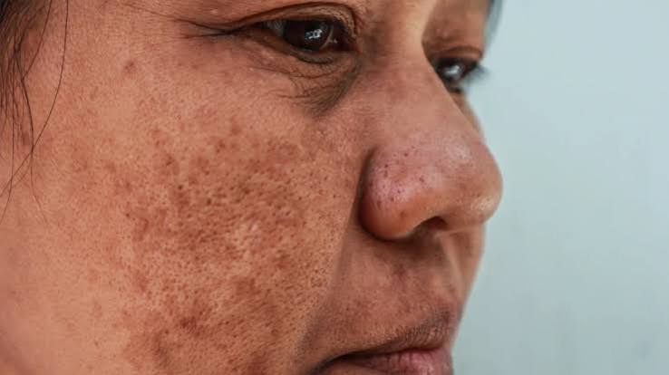 Best Clinic for Adults for Chemical Peel for Melasma Problem