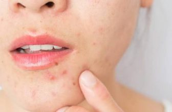 Dr Pretty Singla Review for Acne Treatment in Gurgaon