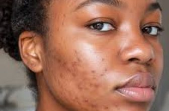 Best Female Dermatologist in Gurgaon for Hormonal Acne Problem
