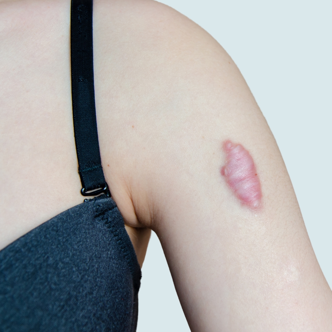 Struggling with a Keloid Scar? Here is How to Find Relief