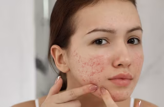 Dealing with PCOS Skin Issues? You Are Not Alone