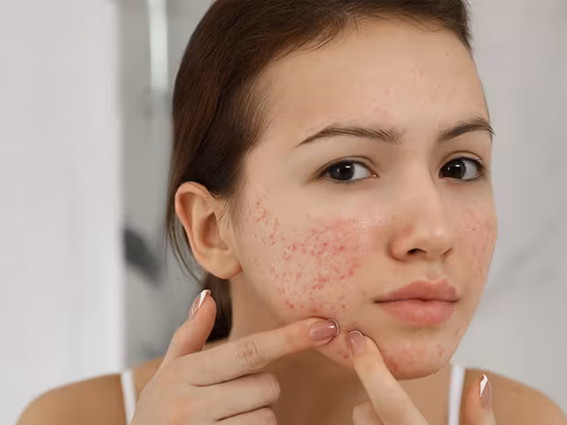 Dealing with PCOS Skin Issues? You Are Not Alone