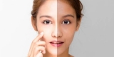 Best Aftercare Routine for Women After Skin Whitening Treatment Problem