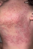 Best Aftercare Tips for Adults for Post Laser Hair Removal Problem