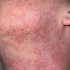 Best Skin Care Routine After Chemical Peel Treatment Problem