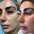 Best Treatment for Adults for Laser Toning for Uneven Skin Tone Problem