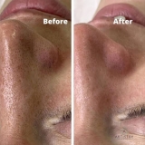 Best Clinic for Women for Chemical Peel for Open Pores Problem