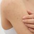 Best Treatment for Adults for Perioral Dermatitis Problem