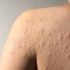 Best Skin Clinic in Gurgaon for Men’s Skincare Problem