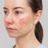 Best Treatment for Women for Chloasma Skin Problem