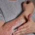 Best Remedy for Teenagers for Fungal Acne Problem