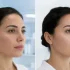 Best Treatment for Teenagers for Salicylic Acid Peel for Acne Problem
