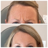 Best Dermatologist for Women for Botox for Forehead Lines Problem